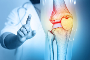 Osteoarthritis