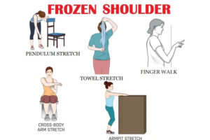 Frozen Shoulder