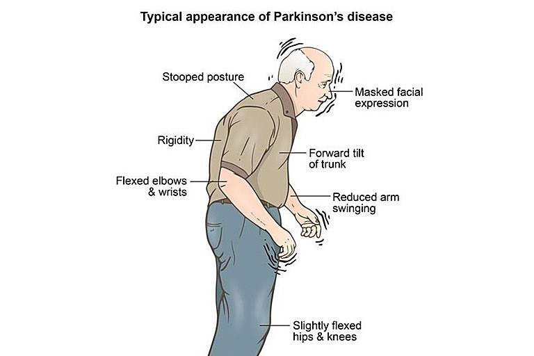 Parkinson’s Disease