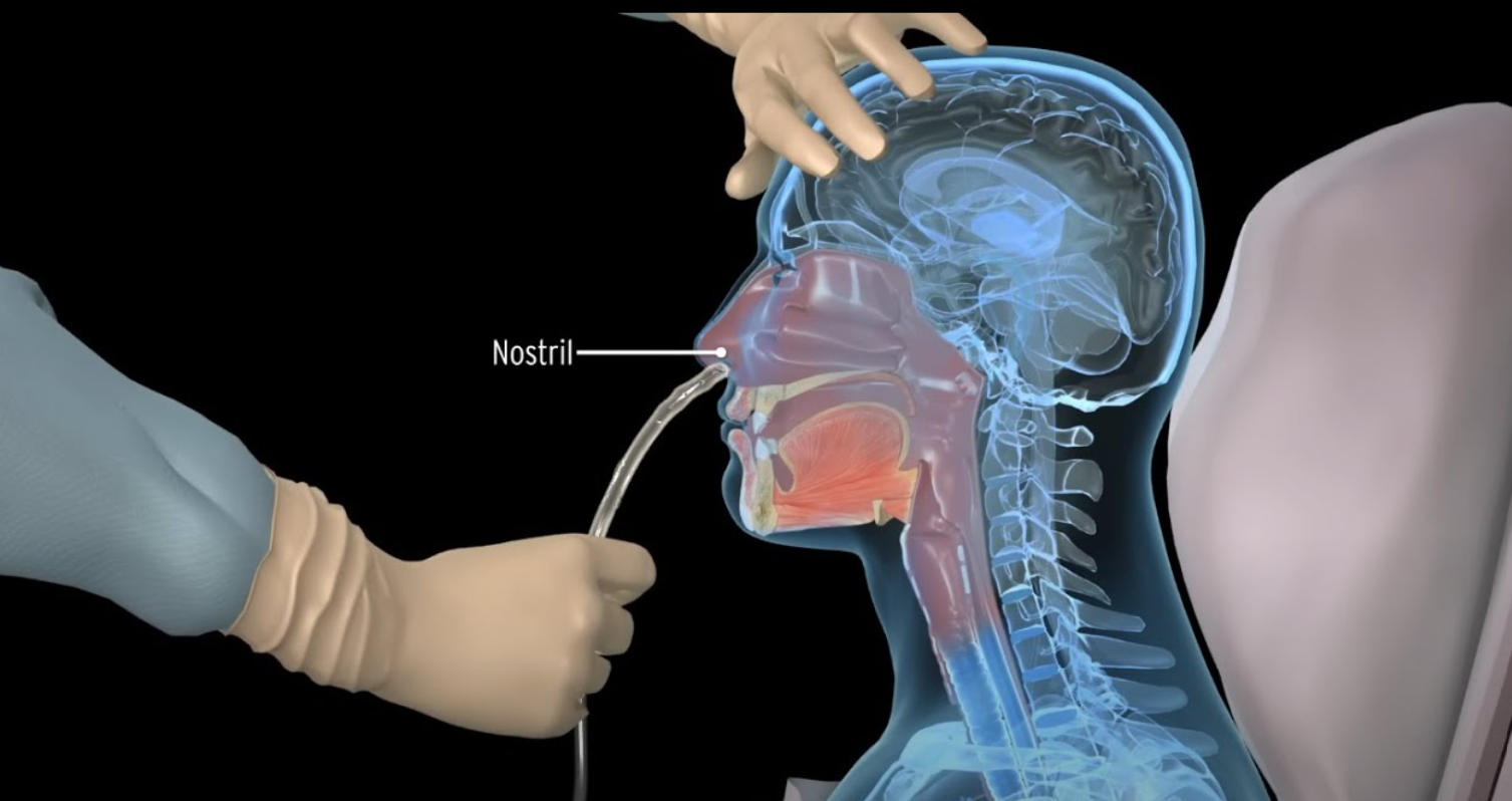 Ryle’s Tube Insertion at Home