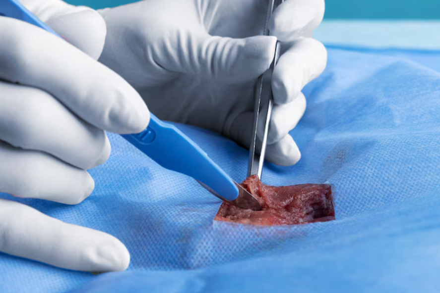 Suture Removal at Home